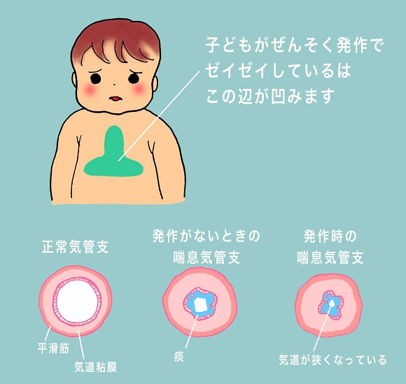 子供が喘息の時の気管支の状態